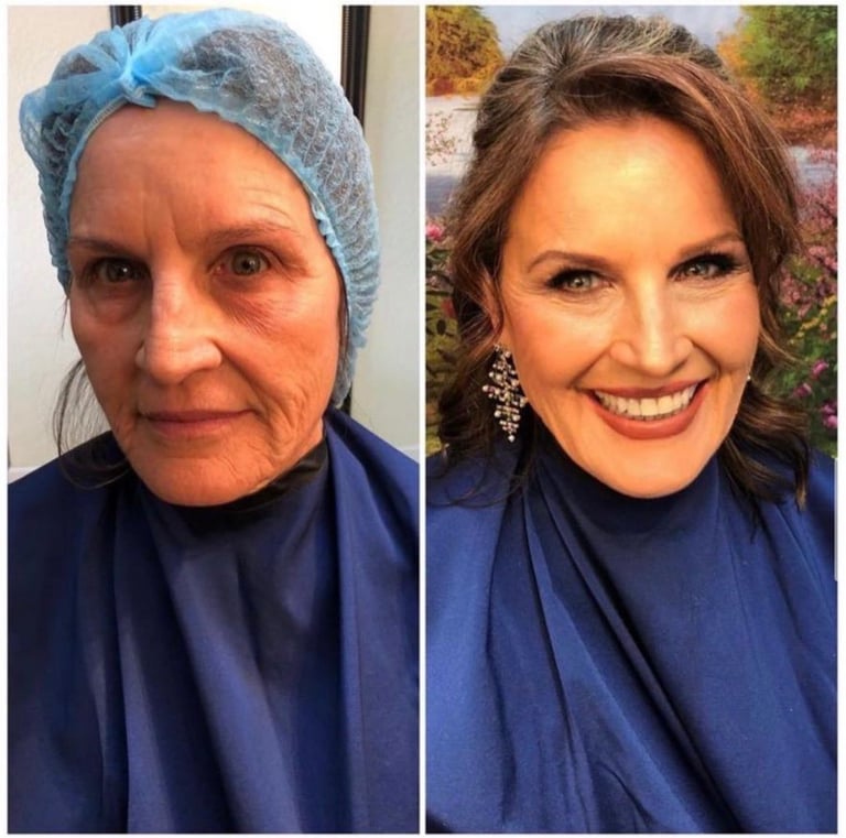 Before and after comparison of a woman showing skin rejuvenation results